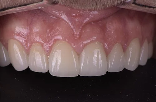 Close-up of upper front teeth and gums.