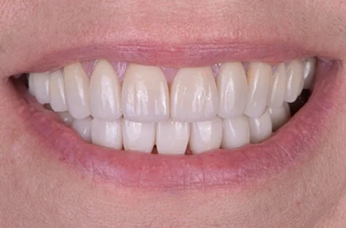 Close-up of a smiling mouth with white, aligned teeth.