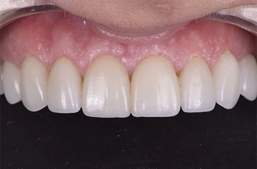 Close-up of upper front teeth and gums.