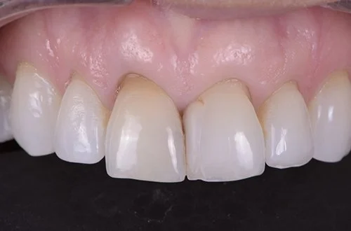 Close-up of a person's upper front teeth, showing some discoloration and chipping.