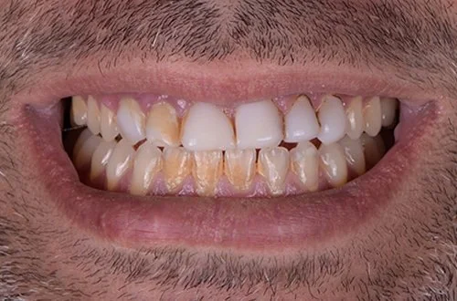 Close-up of a person's mouth showing stained and crooked teeth.