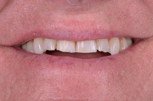 Close-up of a person's mouth showing crooked, discolored, and chipped teeth.