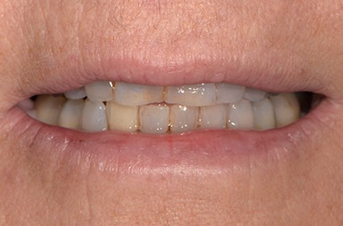 Close-up of a person's mouth showing white teeth with some stain and plaque.