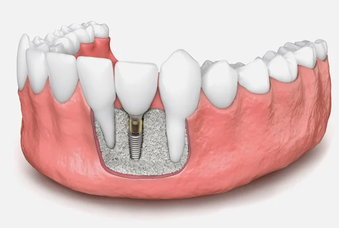 A digital illustration of a dental implant in the lower jaw, showing a metal screw inserted into the bone beneath the gum, with surrounding teeth and pink gum tissue.
