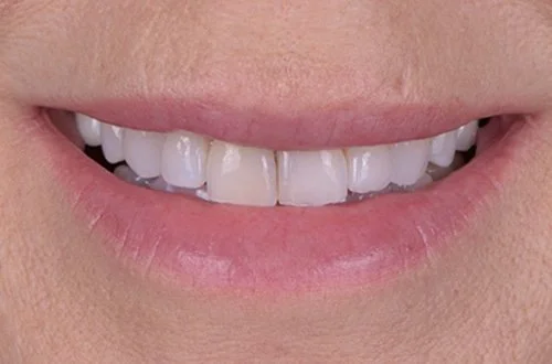Close-up of a smiling person's teeth and lips