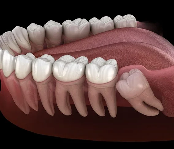 Diagram of human teeth with impacted wisdom tooth growing horizontally behind the second molar.