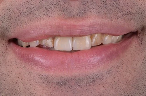Close-up of a person's mouth showing uneven and broken teeth.