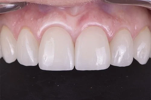 A close-up of clean, straight upper front teeth and pink gums.
