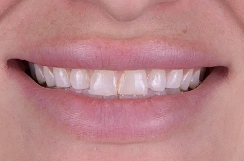 Close-up of a person's smile showing teeth with some gaps and slight misalignment.