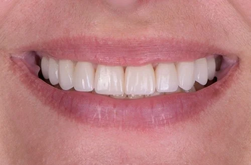Close-up of a person's smiling mouth showing their teeth and lips.