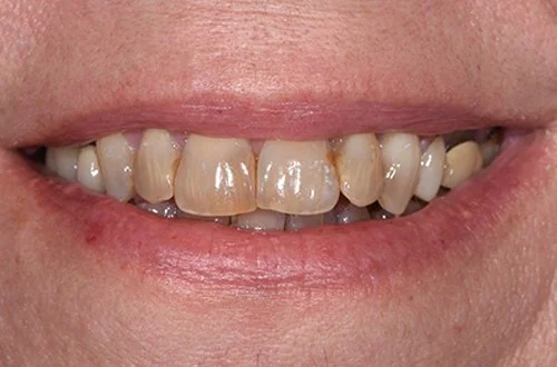 Close-up of a person's teeth with noticeable discoloration and uneven alignment.
