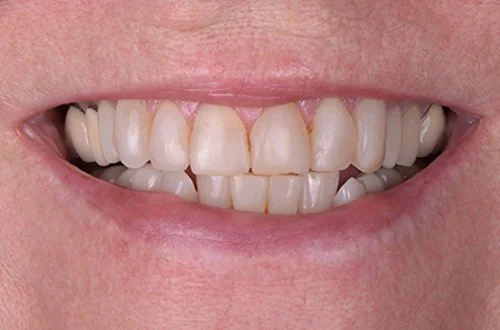 Close-up of a person's smile showing slightly misaligned upper teeth with some discoloration.