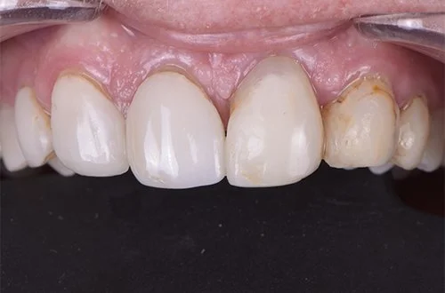 Close-up of upper front teeth, some with signs of discoloration or plaque.