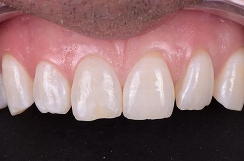 Close-up of a set of upper front teeth showing minor chips and uneven edges.