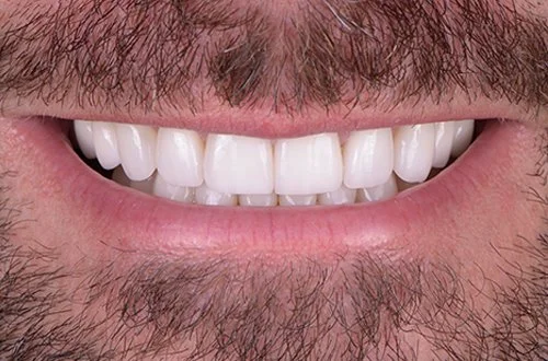 Close-up of a smiling person's mouth showing white teeth and facial hair.