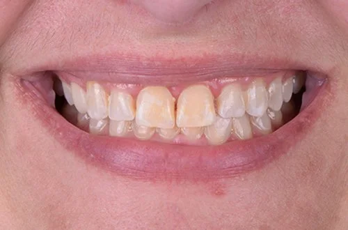 Close-up of a person's smile showing crooked and discolored teeth.