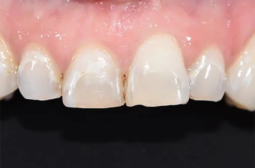 Close-up of a set of front teeth showing signs of enamel wear and chipping.