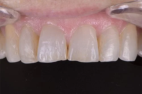 Close-up of front teeth with visible dental impressions and slight chipping on one of the lower teeth.