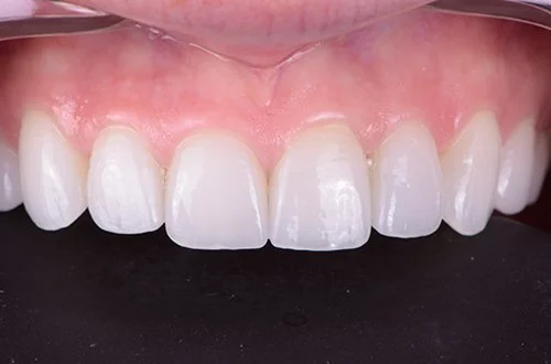 Close-up of a person's upper front teeth and gums, showing healthy white teeth.