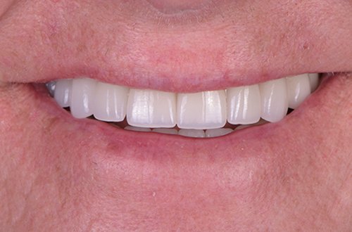 Close-up of a person's smile showing upper teeth with dental veneers.