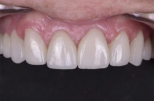 Close-up of a smiling person's upper front teeth and gums.
