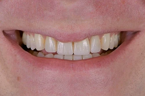 Close-up of a person's smile showing their teeth with some discoloration and slight misalignment.