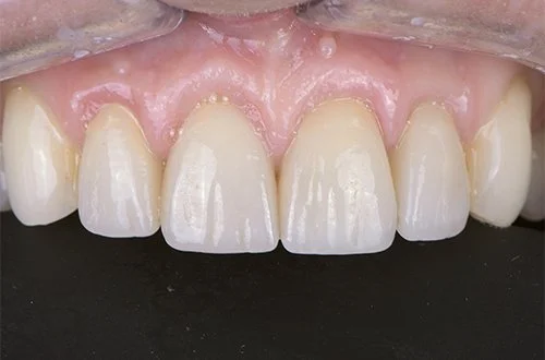 Close-up of upper front teeth with gap and healthy gums