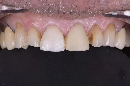 Close-up of damaged and discolored upper front teeth.