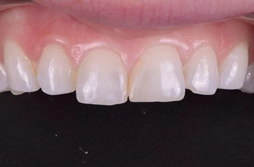 Close-up of upper front teeth with minor irregularities and slight discoloration.