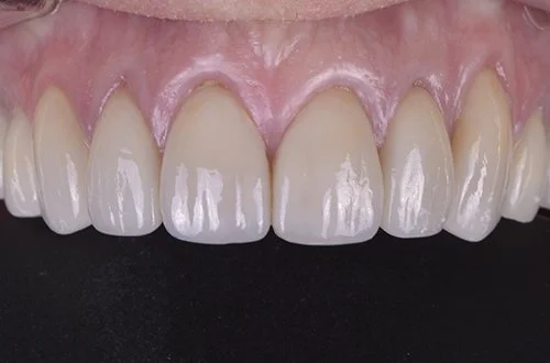 Close-up of upper front teeth and gums with healthy appearance.