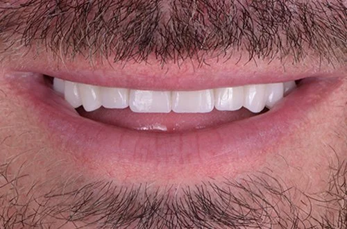 Close-up of a person's mouth showing smiling lips, white teeth, and facial hair.