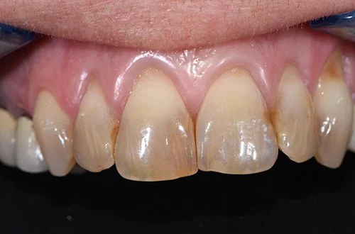 Close-up of stained and chipped upper front teeth in a person's mouth.