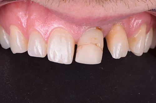 Close-up of damaged and decayed upper front teeth with visible cavities and discoloration.