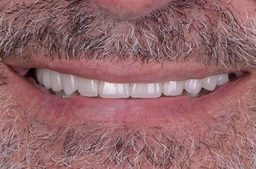 Close-up of a smiling person's mouth showing white teeth and facial hair.