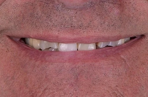 Close-up of a person's mouth with visible teeth, some of which are uneven and slightly discolored.