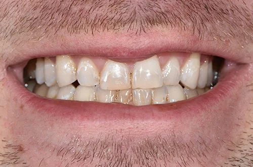 Close-up of a person's teeth with signs of discoloration and misalignment.