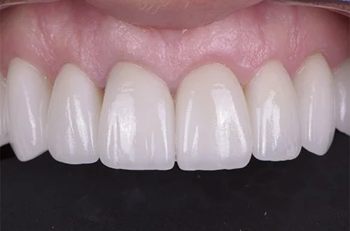 Close-up of a person's upper front teeth, showing well-aligned, white teeth with pink gums.