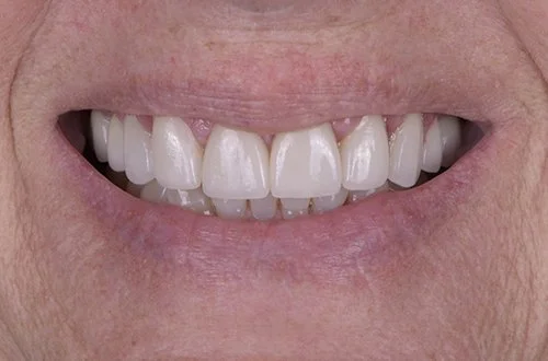 Close-up of a person's smiling mouth showing upper front teeth with some uneven coloring.