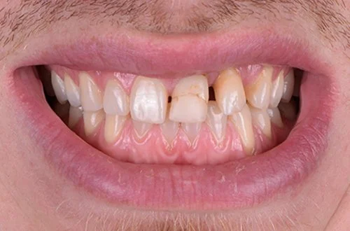 Close-up of a person's teeth with visible decay and misalignment