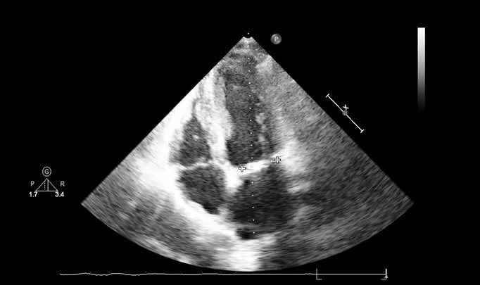 Echocardiogram of heart