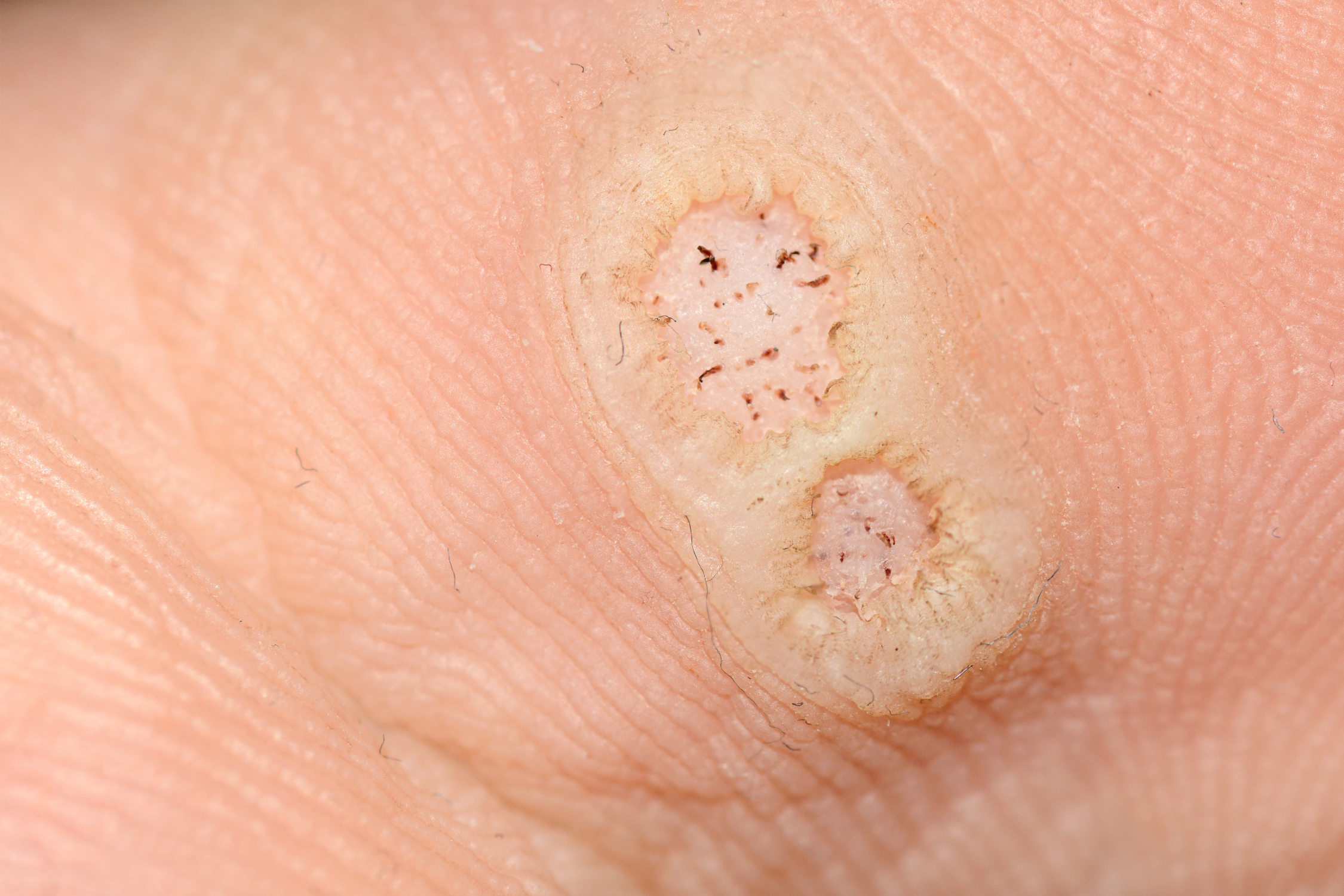 plantar warts