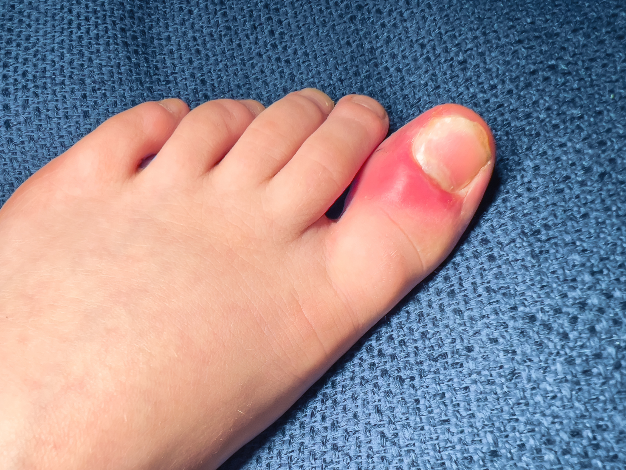 ingrown toenail