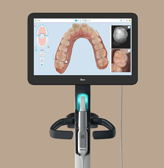 iTero digital scanner used for Invisalign treatment planning