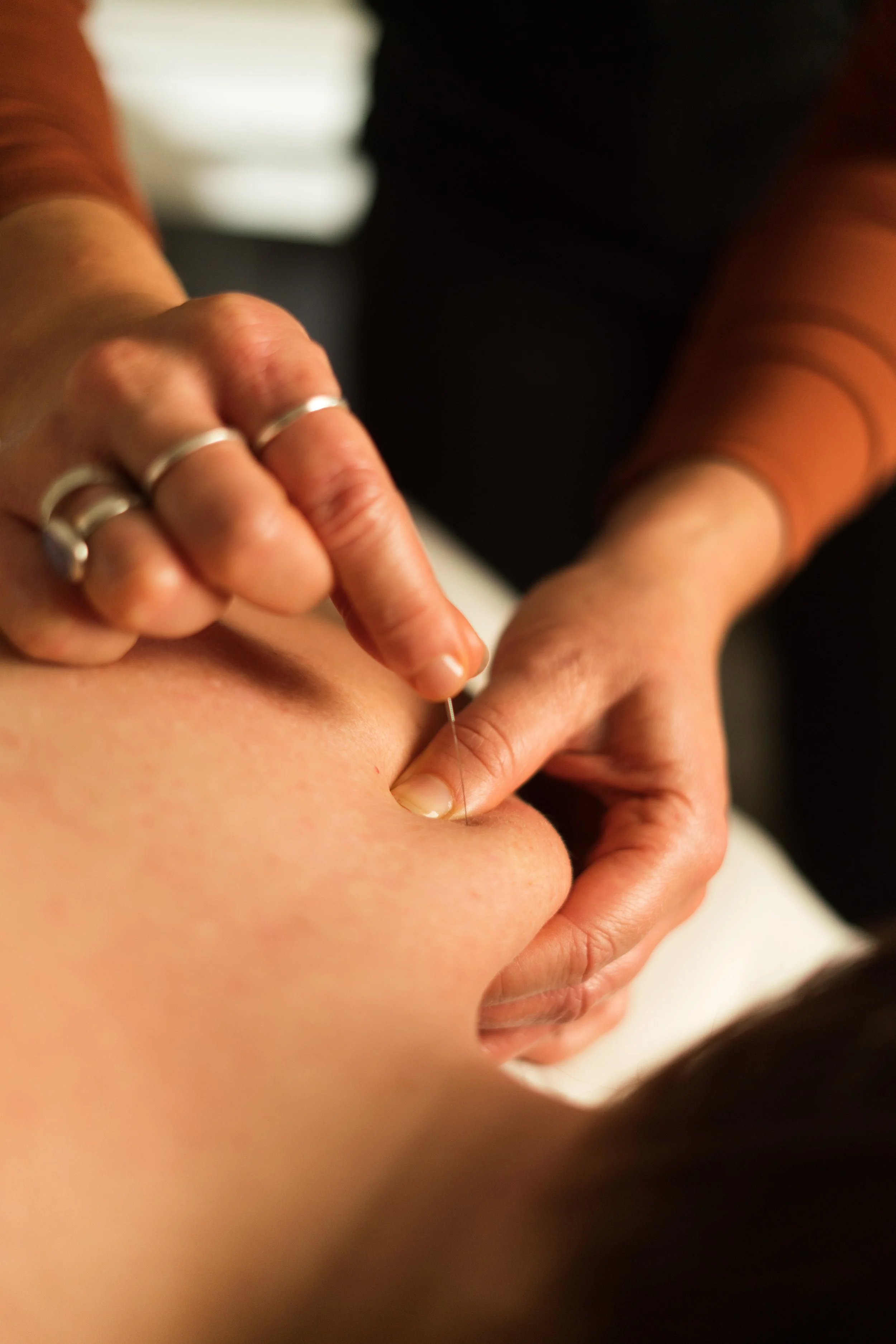 A person receiving acupuncture treatment, with a practitioner inserting a thin needle into their skin on their face.