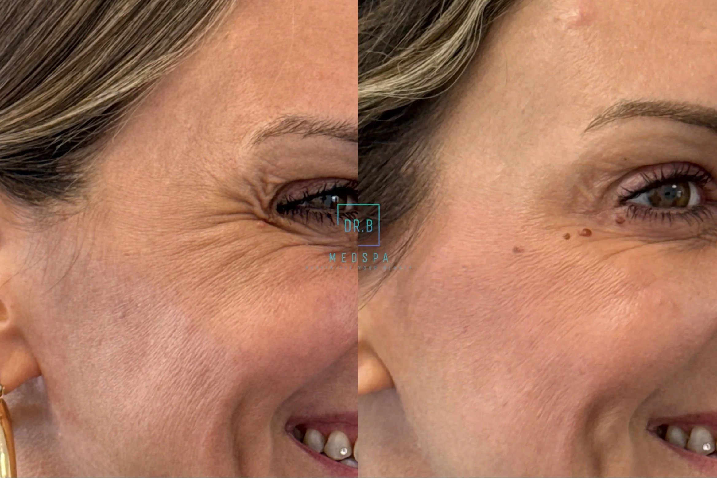 botox bend crows feet treatment before after.jpeg