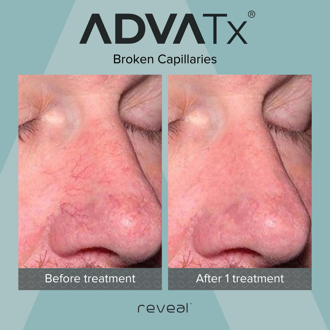 Side-by-side comparison of a person's nose before and after treatment, showing improved skin condition, with less redness and visible broken capillaries after one treatment.