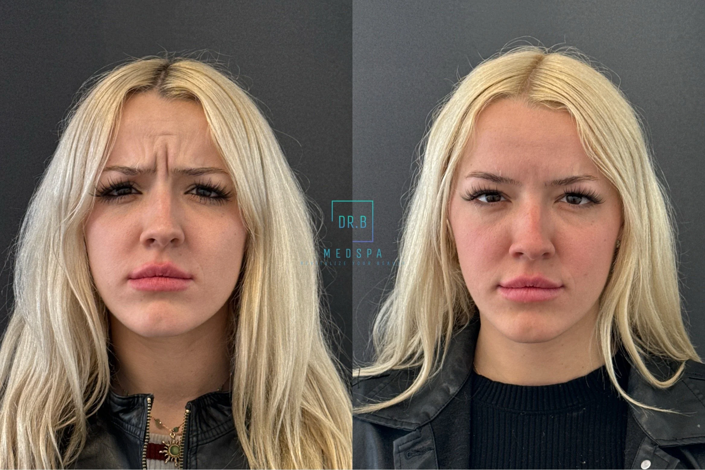 botox 2.jpeg