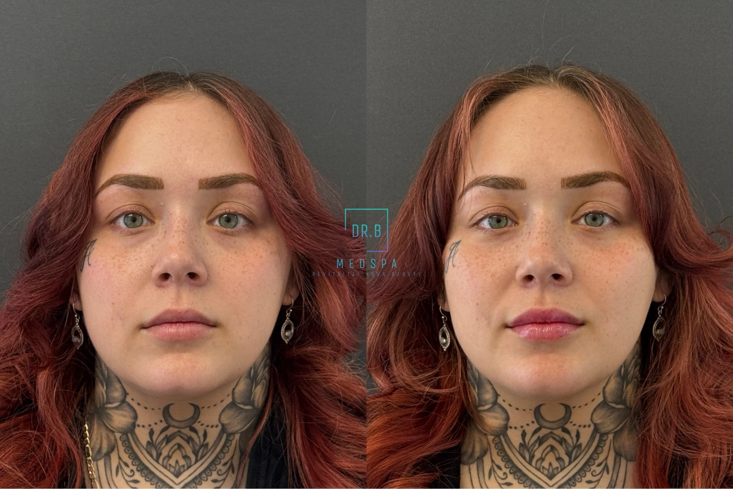 lip filler.jpeg
