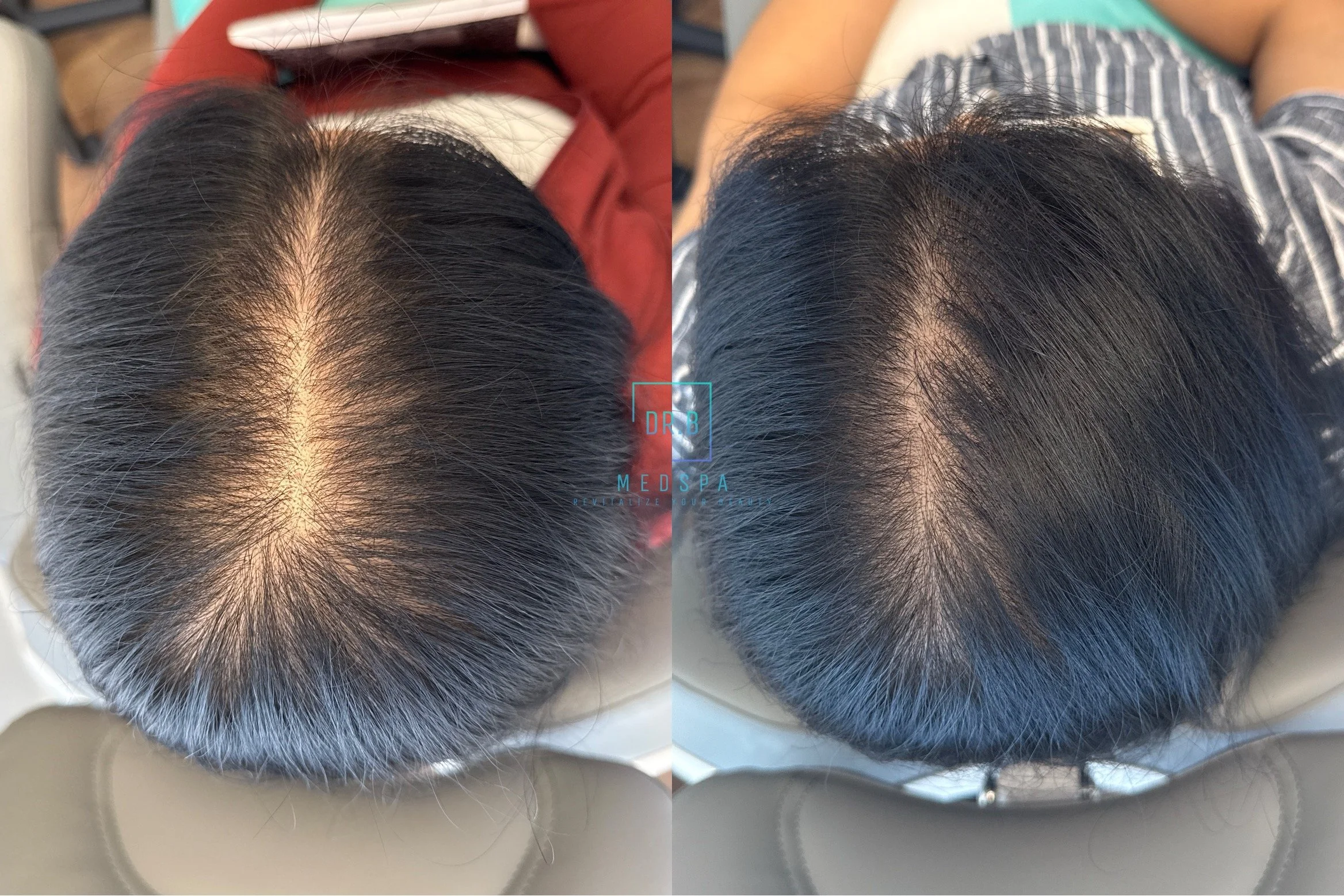 Top view of a person's head showing dark hair with gray strands, divided into two sections with a slight difference in hair density. The person is seated, and the background includes a white chair and a patterned shirt.