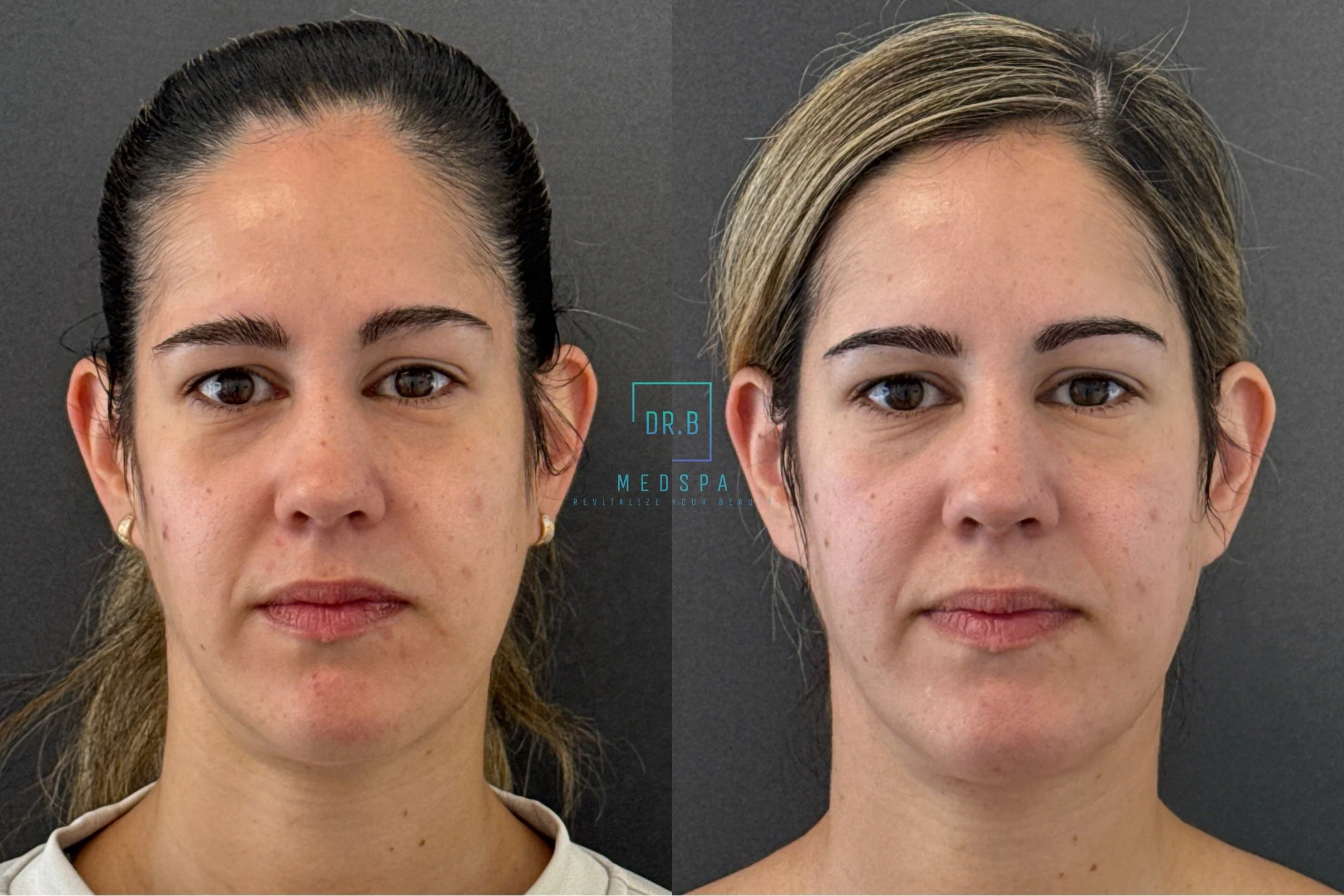 botox.jpeg